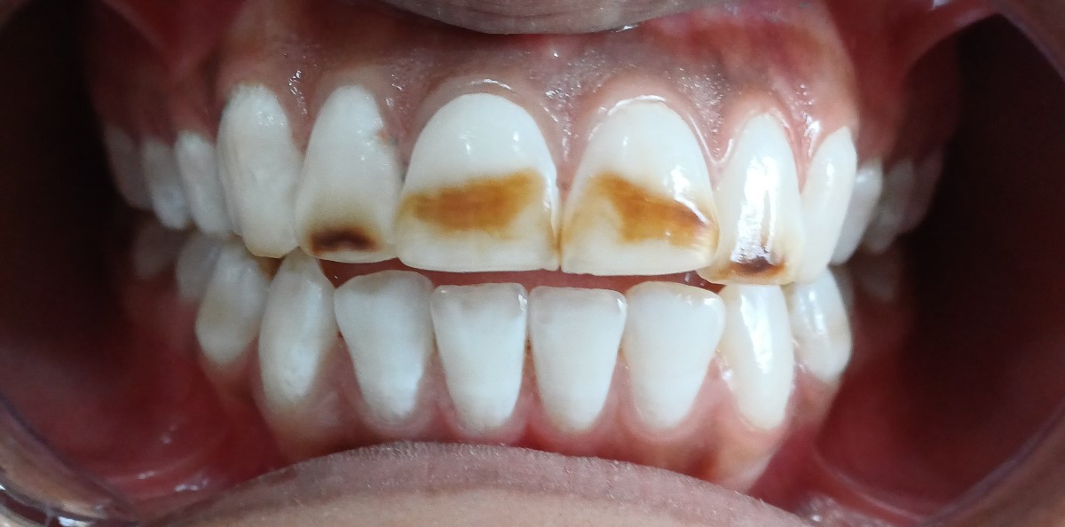 Before Image